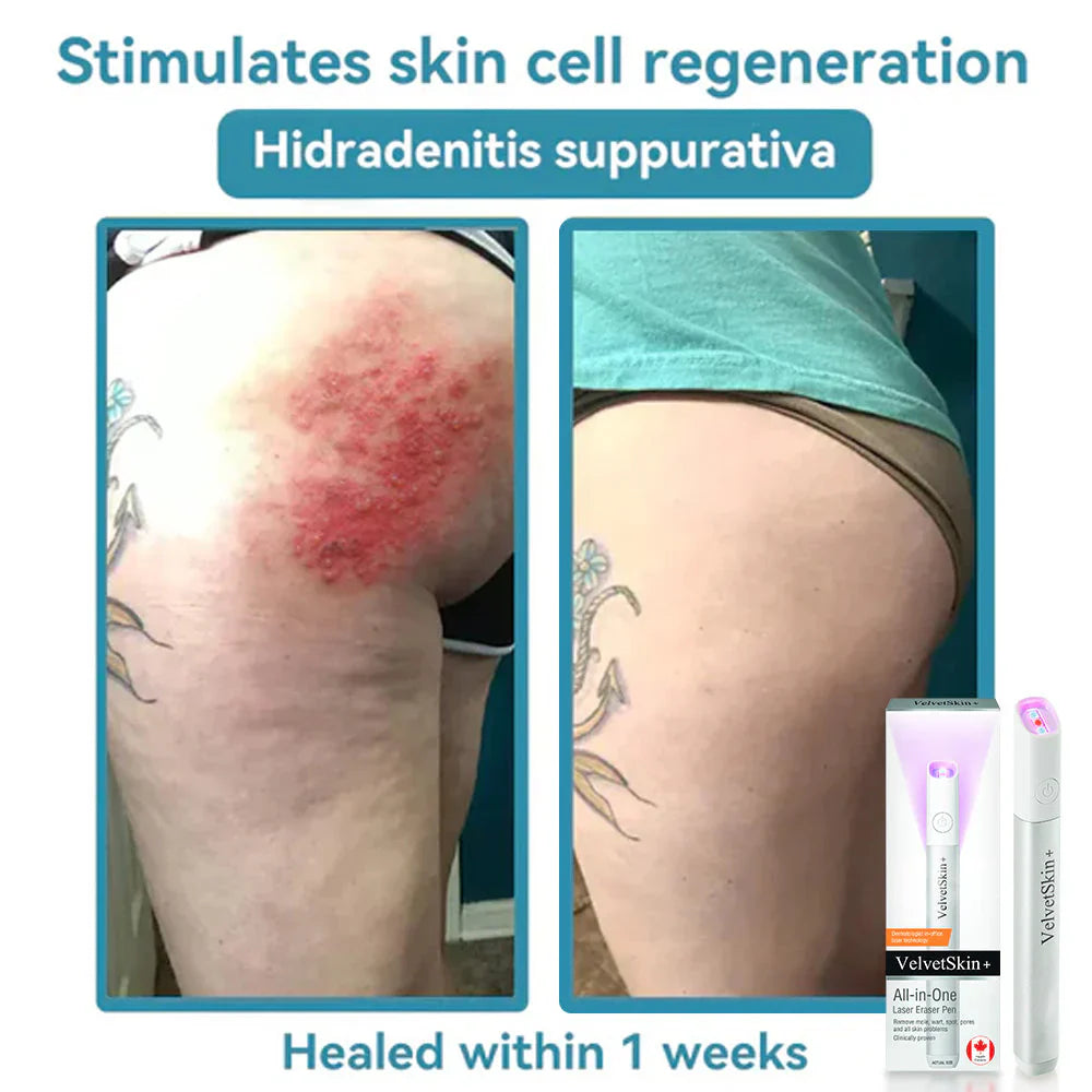 🇨🇦 Bikenda® VelvetSkin+ All-in-One Laser Eraser Pen(Powered by CO₂ laser technology – effectively removes moles, warts, skin tags, pigmentation spots, and other skin imperfections)