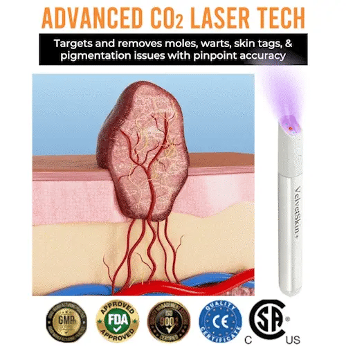 🇨🇦 Bikenda® VelvetSkin+ All-in-One Laser Eraser Pen(Powered by CO₂ laser technology – effectively removes moles, warts, skin tags, pigmentation spots, and other skin imperfections)